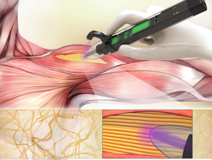 Device Prints Scaffolds Inside Wounds to Replace Lost Tissue