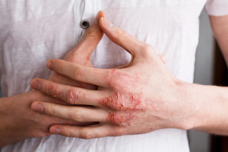 6 Useful Apps and Devices for Managing Eczema or Atopic Dermatitis