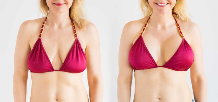 Don’t Want Surgery? Here Are 10 Non-Surgical Breast Lift Alternatives