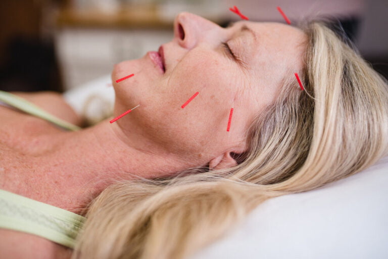 What is Facial Acupuncture? Can This really Make You look Younger?