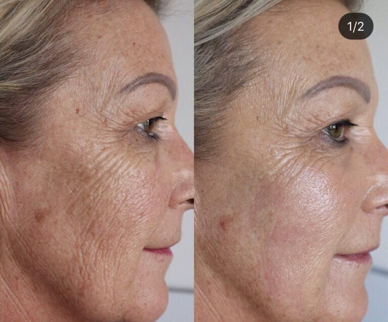 ALL YOU NEED TO KNOW ON PLASMA FIBROBLASTING TREATMENT