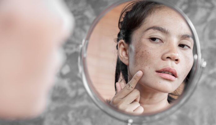 Is Melasma Curable And What Are Your Best Treatment Options?