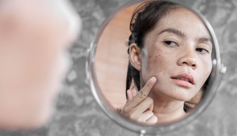 Is MELASMA Curable And What Are Your Best Treatment Options?