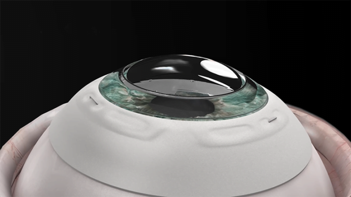 CorNeat Synthetic Cornea Implanted in First Patient CorNeat Synthetic Cornea Implanted in First Patient