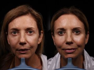 Facelift