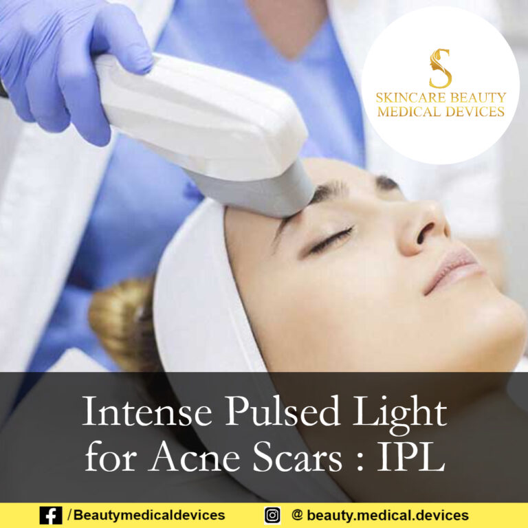 Intense Pulsed Light for Acne Scars : IPL