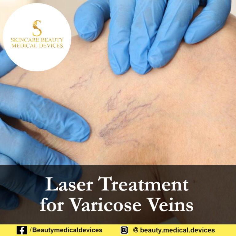 Laser Treatment for Varicose Veins