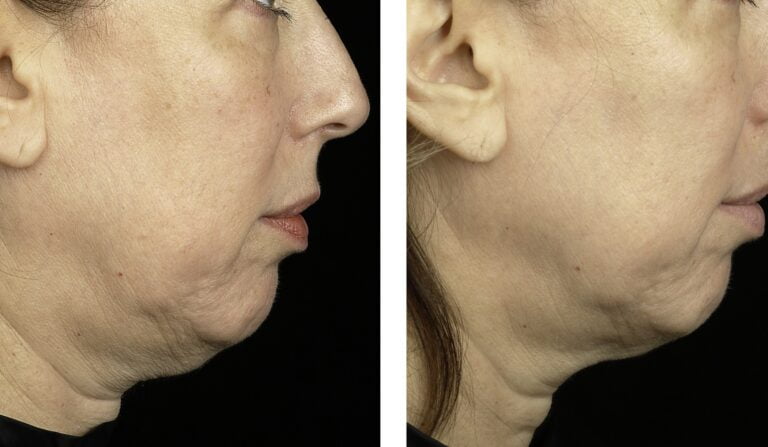 Thermage Neck Lift: Taking The Right Path Towards A Better Natural Look