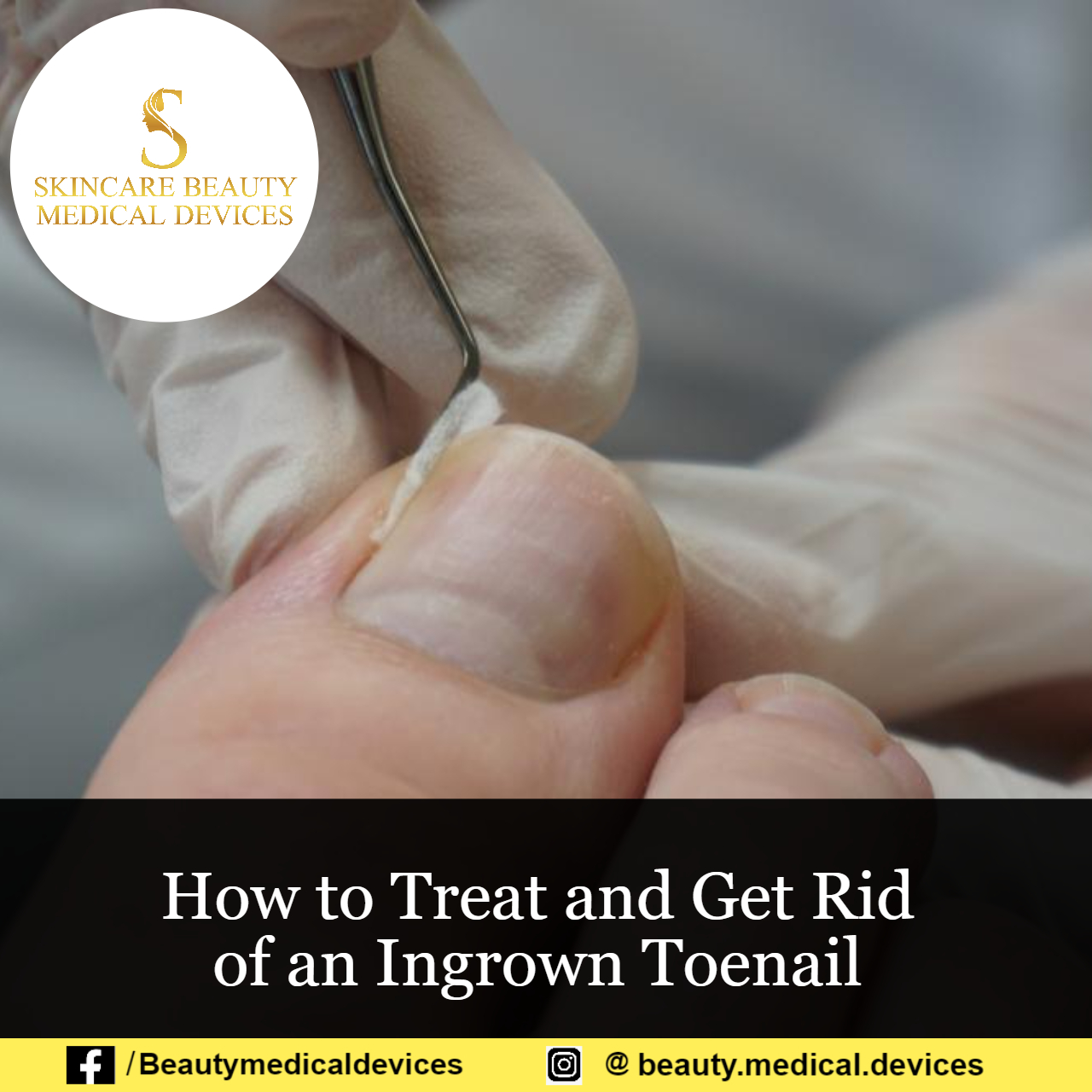 How To Treat And Get Rid Of An Ingrown Toenail : Nail Treatment