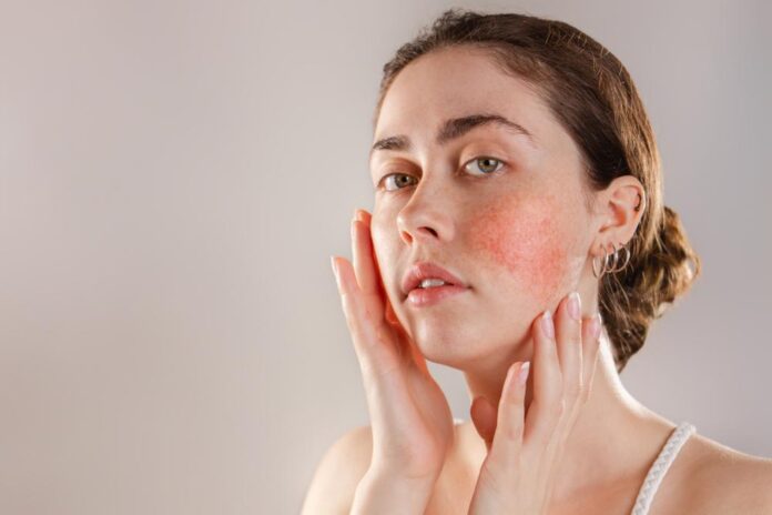 How Can You Stay Beautiful With Eczema?
