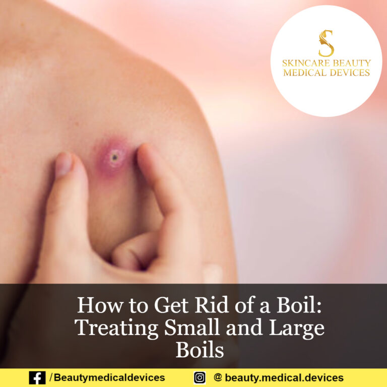 How to Get Rid of a Boil: Treating Small and Large Boils