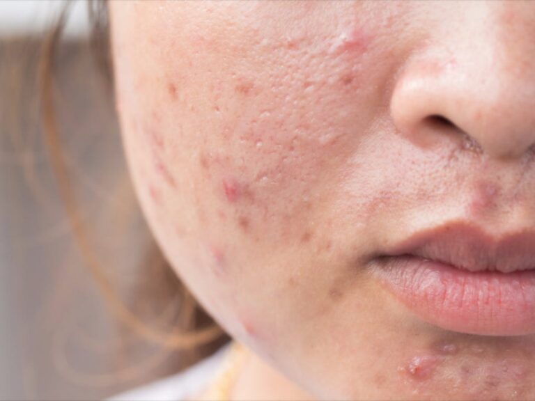 How to Get Rid of Cystic Acne Treatment , According to Dermatologists