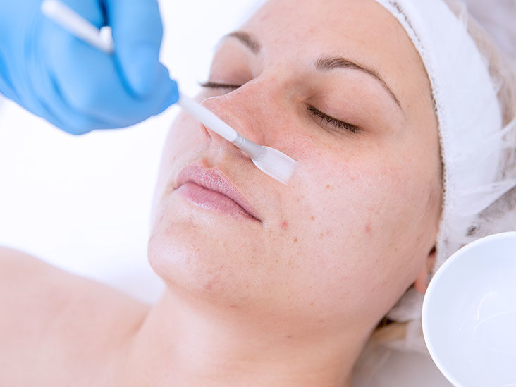 The Facts About Chemical Peels Beauty Devices