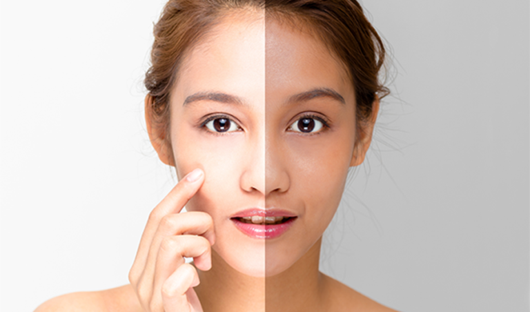 Let’s Talk About Skin Lightening treatment and its types
