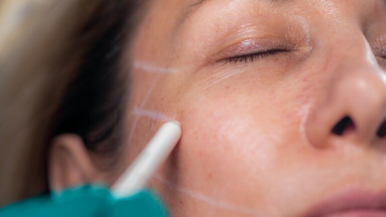Smooth out your Wrinkles without any pain or downtime