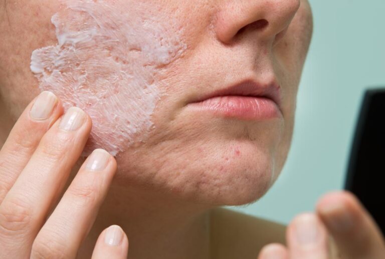 Is Glycolic Acid a Good Acne Treatment?