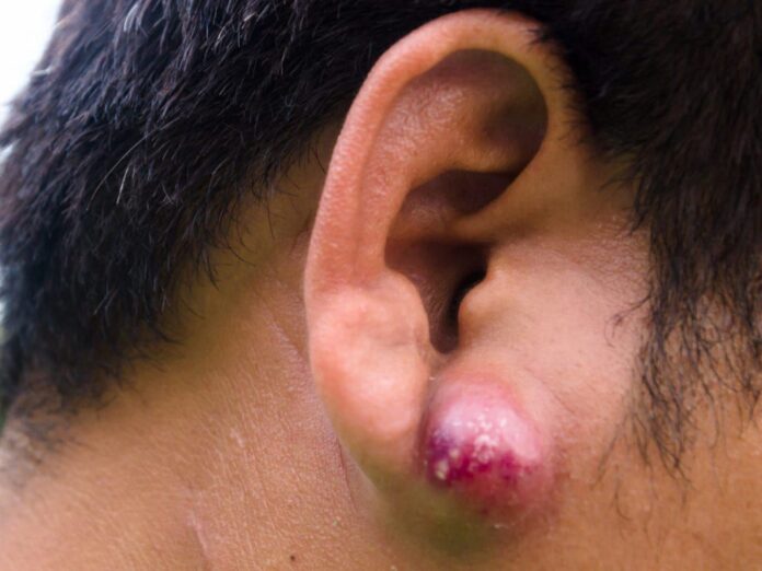 How To Deal With Skin Abscess: Everything You Need To Know