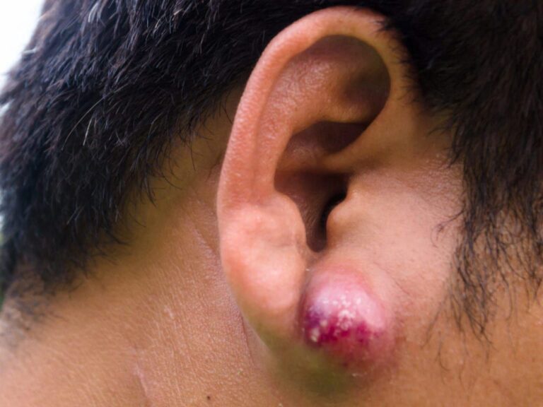 How To Deal With Skin Abscess: Everything You Need To Know
