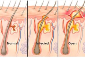 Small boils can usually be treated on your own at home.