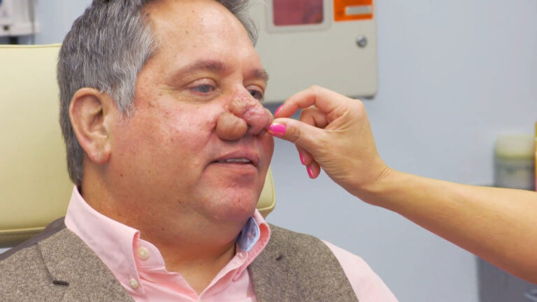RHINOPHYMA: Causes, Risk Factors, Symptoms and Treatment