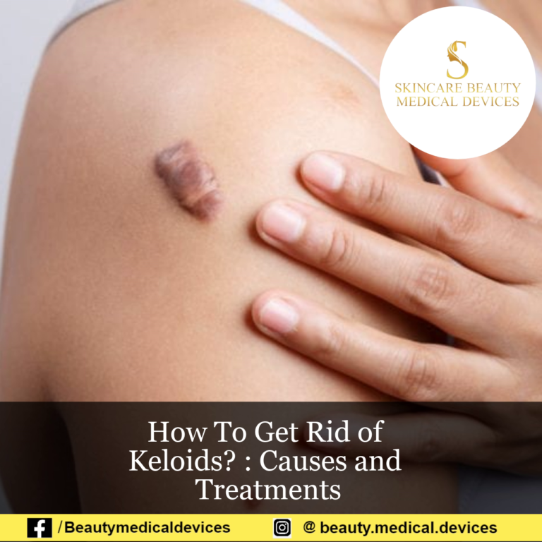 How To Get Rid of Keloids? : Causes and Treatments