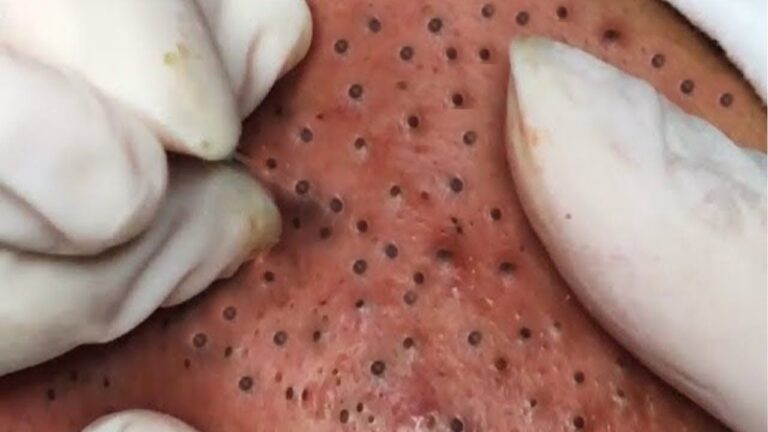 Get Rid of BLACKHEADS: Why Only A Dermatologist Should Do It