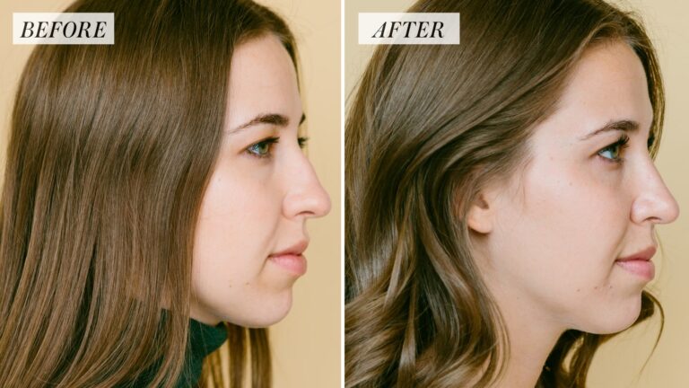 Let’s Talk About Rhinoplasty and its Effects