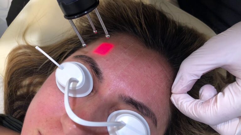 The Best of Acne Treatments: Nano-Ray Laser Skin Resurfacing