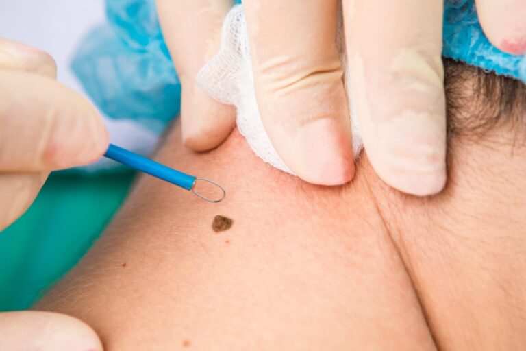 Everything You Need to Know About The Mole Removal Treatment