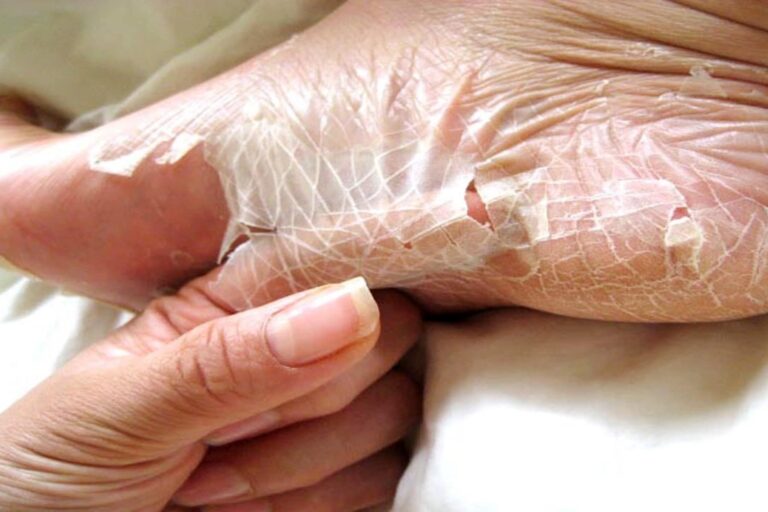 How to Remove Dry Skin From the Feet: 5 Ways & Prevention