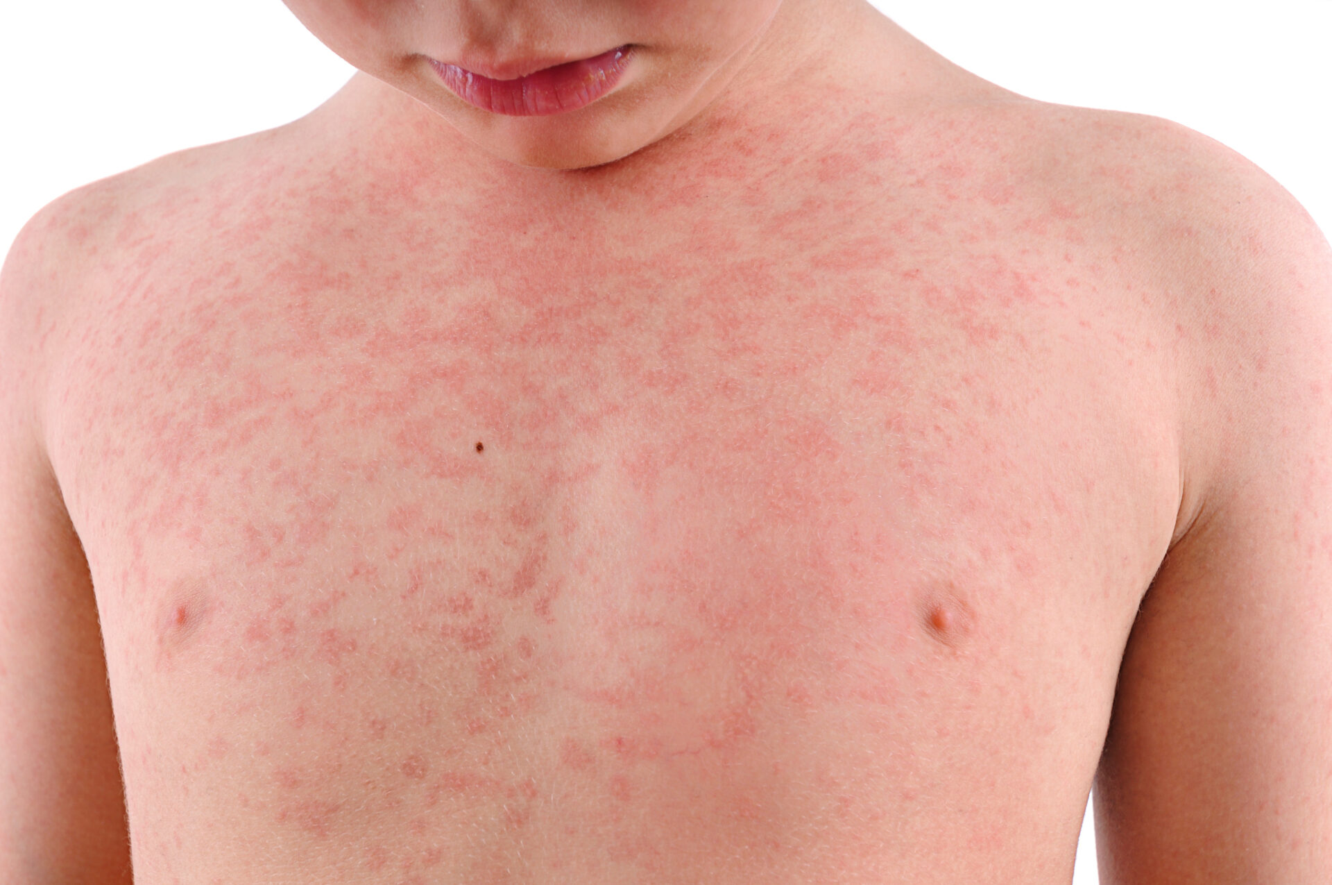 What is Heat Rash, What are the Causes and How do we Treat it?