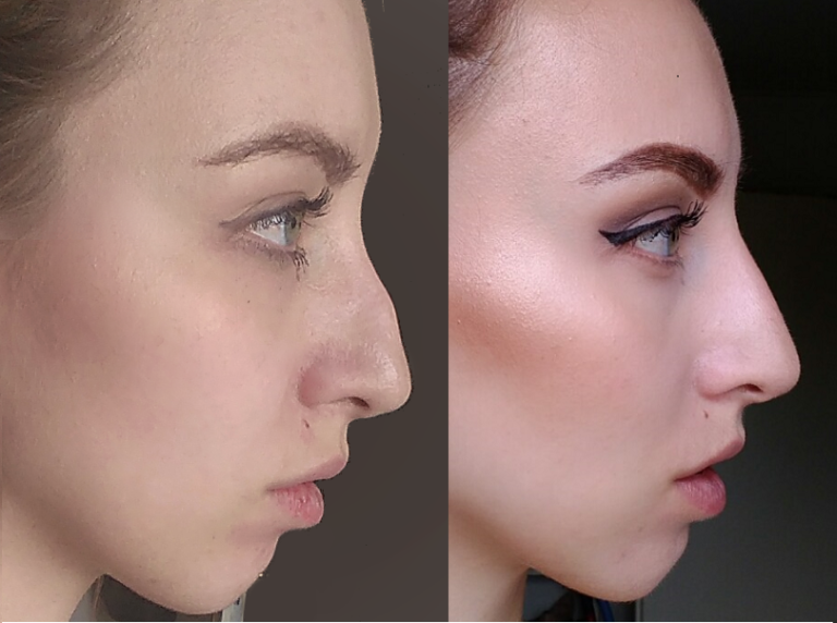 NON-SURGICAL NOSE TREATMENT