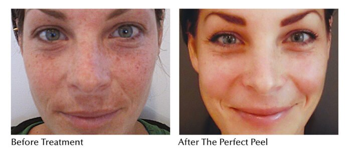 The PERFECT DERMA PEEL: How does it Resurface your Skin?