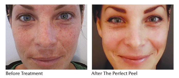 The PERFECT DERMA PEEL: How does it Resurface your Skin?