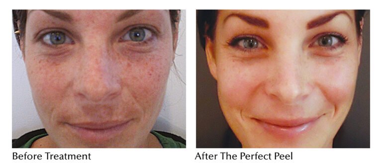 The PERFECT DERMA PEEL: How does it Resurface your Skin?