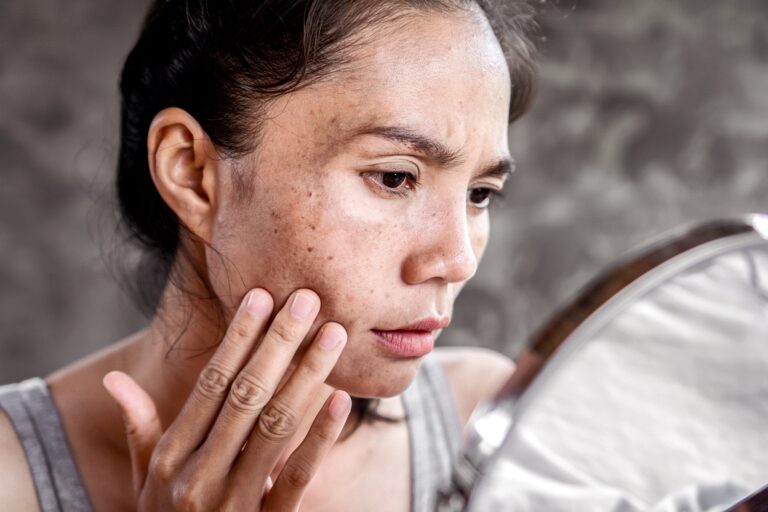 Know The Best Ways How to Get Rid of AGE SPOTS