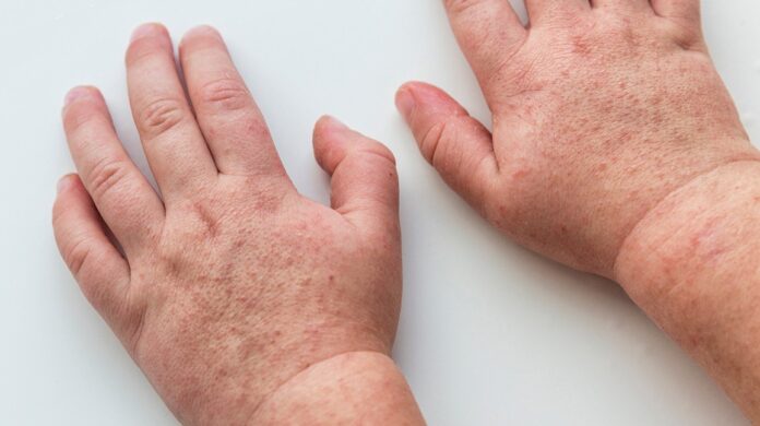 What is scarlet fever?