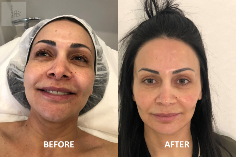 VIVACE Micro-Needling: Newest Generation RF Micro-needling