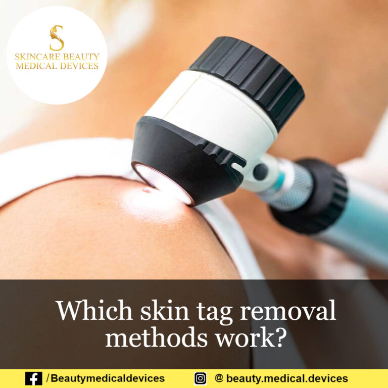 Which skin tag removal methods work?