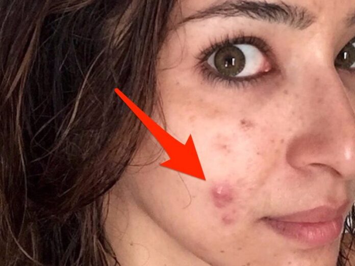 After 15 Years of Cystic Acne, This Drug Finally Cleared Up My Skin