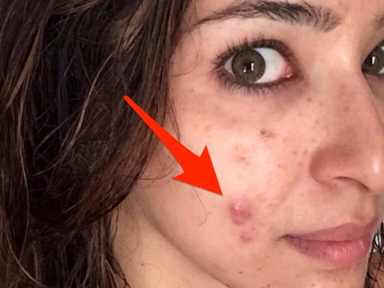 What Is Cystic Acne?