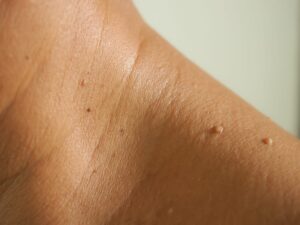 What is a Skin Tag?