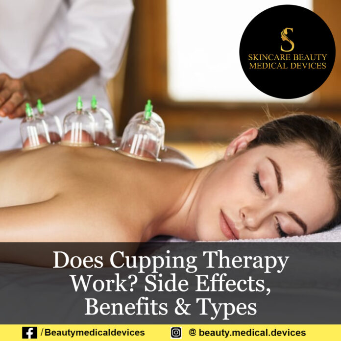 Does Cupping Therapy Work? Side Effects, Benefits & Types