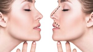 Rhinoplasty Before and After