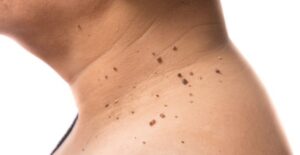 A skin tag is a non-cancerous growth of skin.