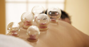 A therapeutic cupping treatment involves warming and placing cups, usually made of glass, on the skin.