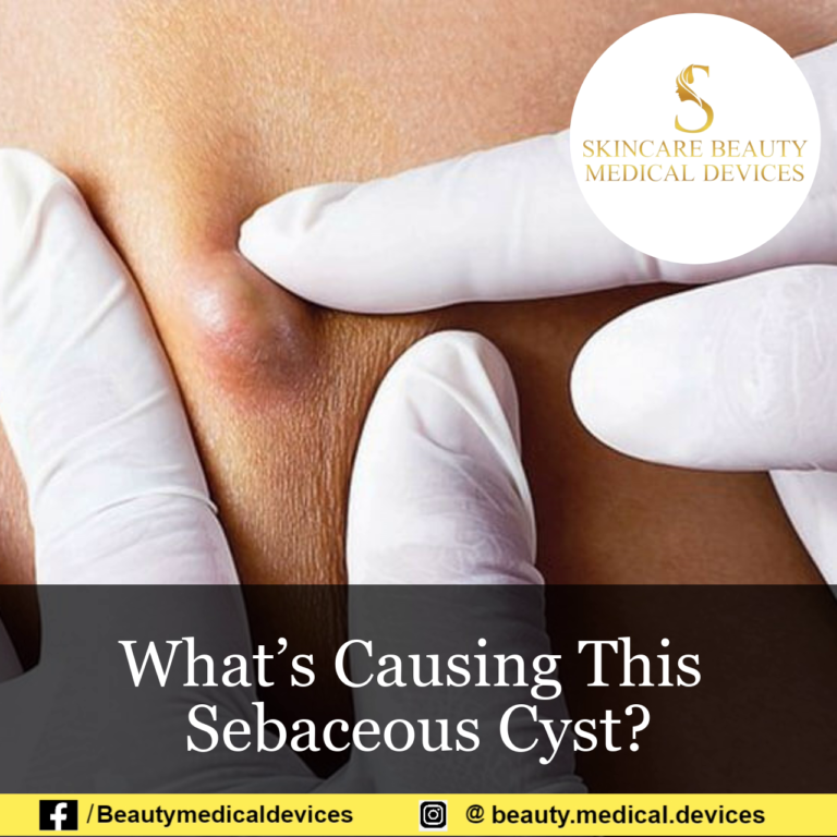 What’s Causing This Sebaceous Cyst?