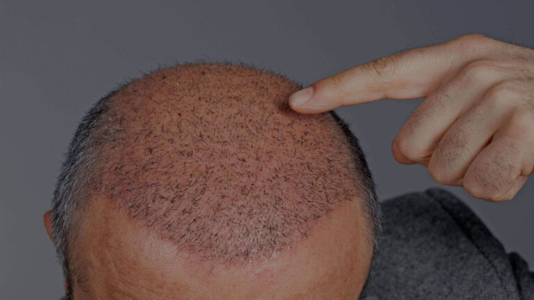 Does Direct Hair Transplantation Technique Really Work?