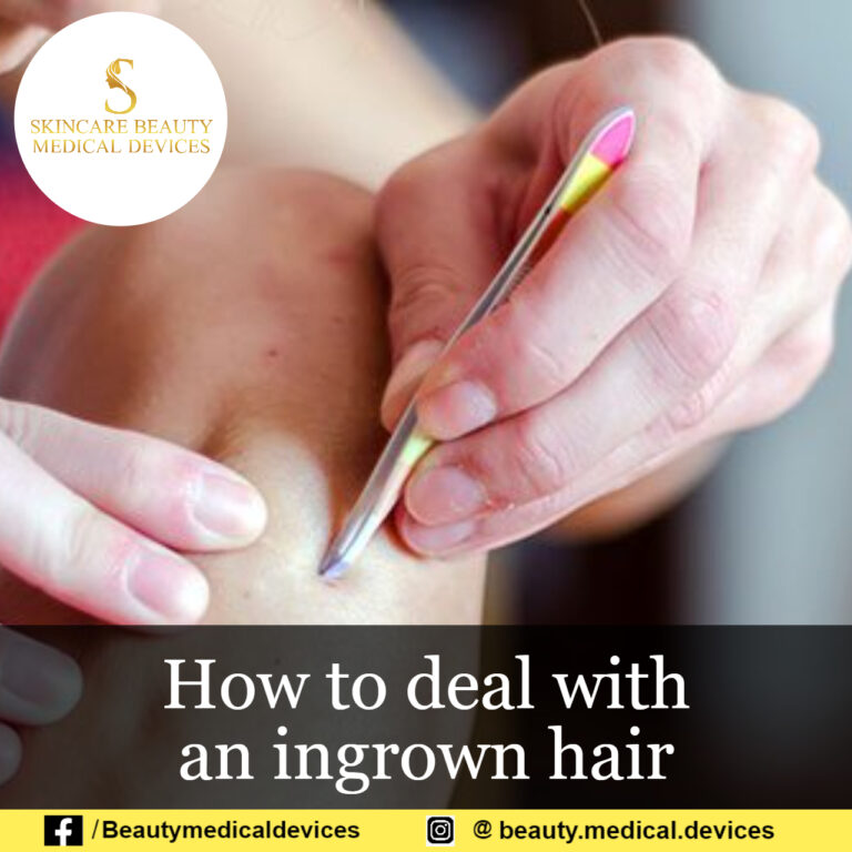 How to deal with an ingrown hair