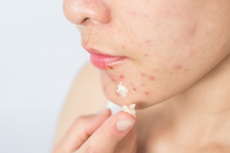 What Should I Do After Popping a Pimple?